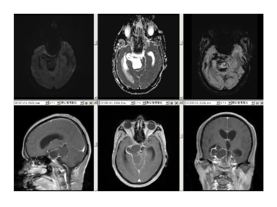 垂体瘤的MR诊断与鉴别诊断