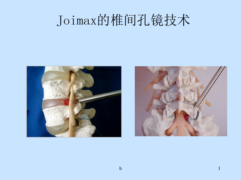 椎间孔镜手术操作方法