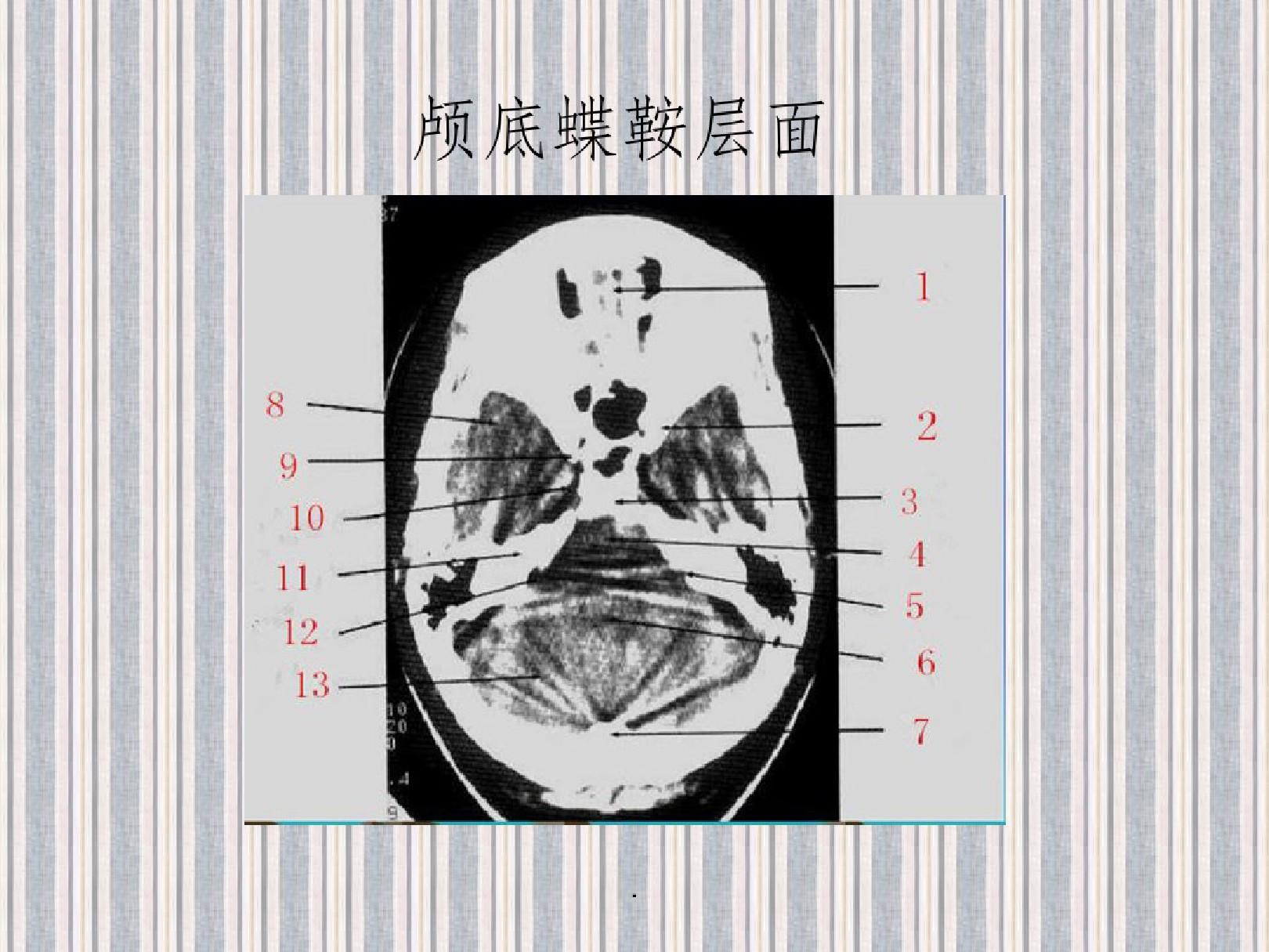 CT断层解剖