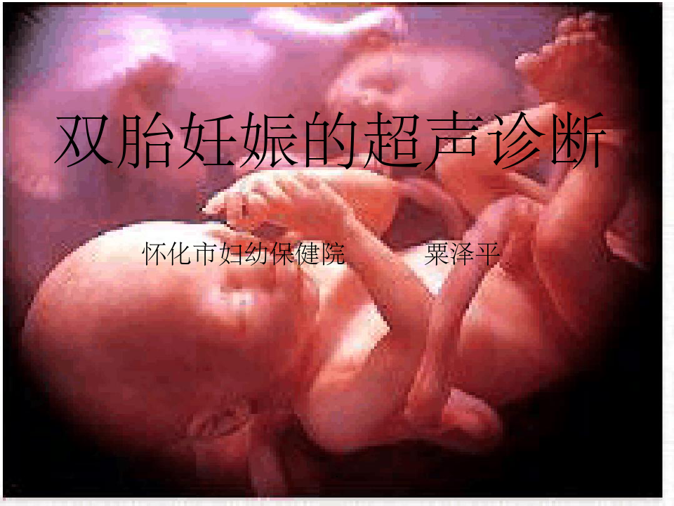双胎妊娠超声诊断