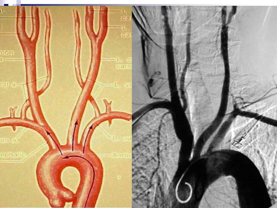 脑血管造影(解剖及影像表现)