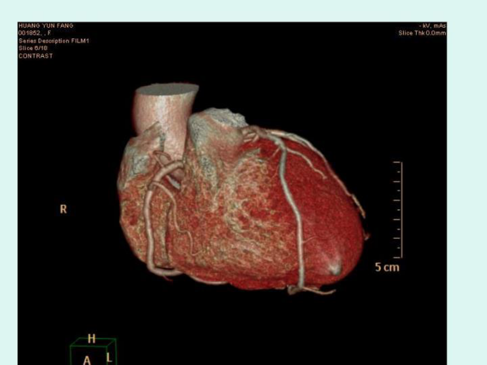 最新[医学]心脏冠状动脉CTA成像PPT课件