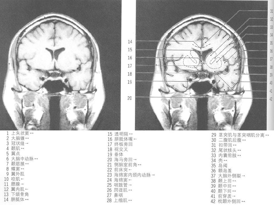 MRI颅脑冠状位解剖图谱(2)