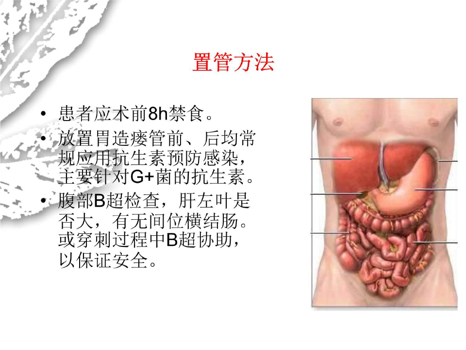 经皮胃镜下胃造瘘术操作与术后护理课件