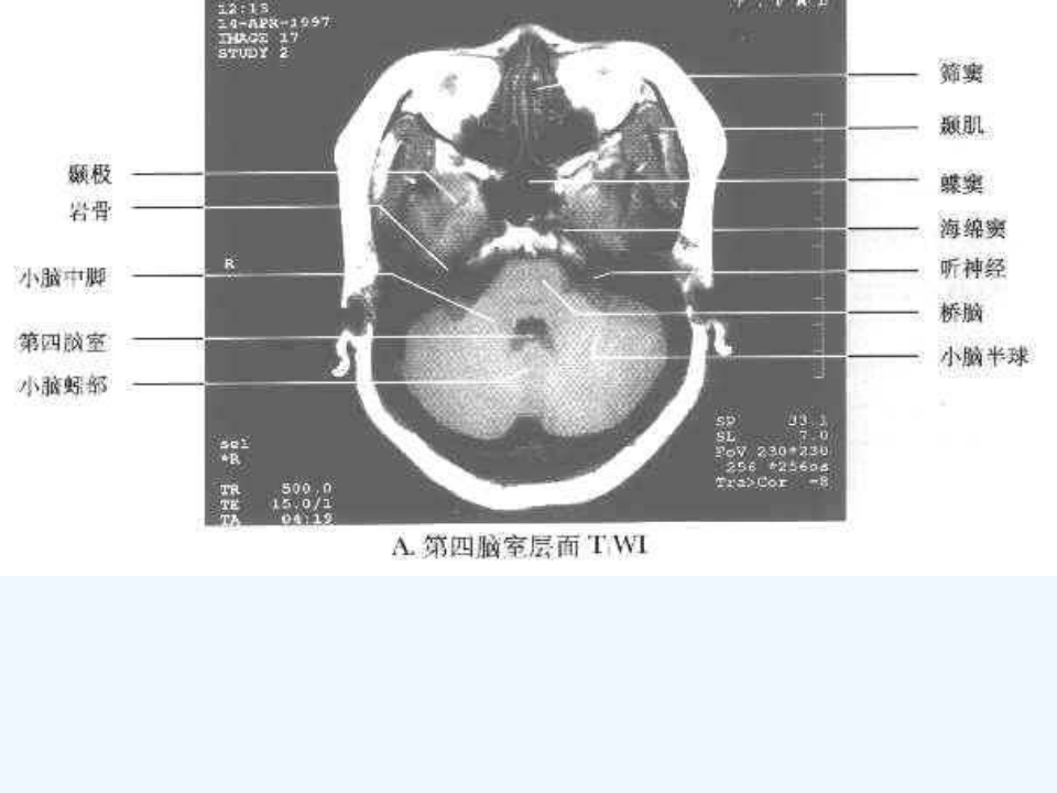 头mri断层解剖图谱