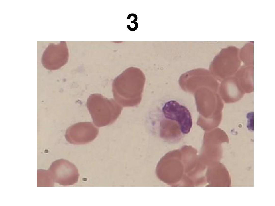 血液细胞图片及详细解析71页PPT