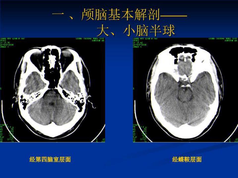颅脑基本CT征象及颅脑外伤性疾病CT诊断 PPT课件