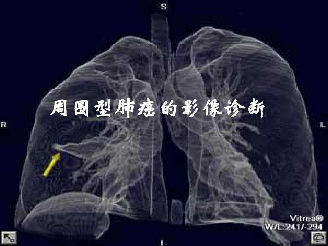 周围型肺癌的影像诊断