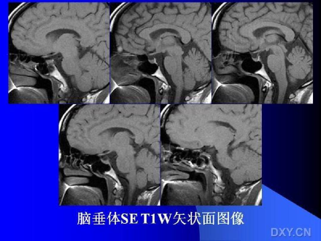 垂体瘤的MRI诊断与鉴别诊断