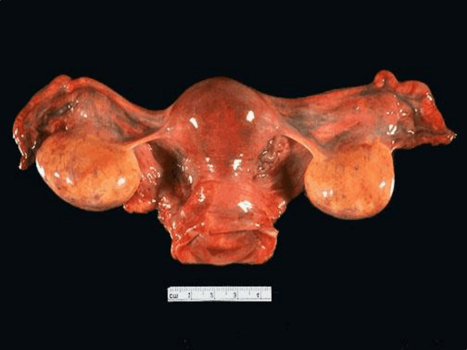 女性生殖系统肿瘤