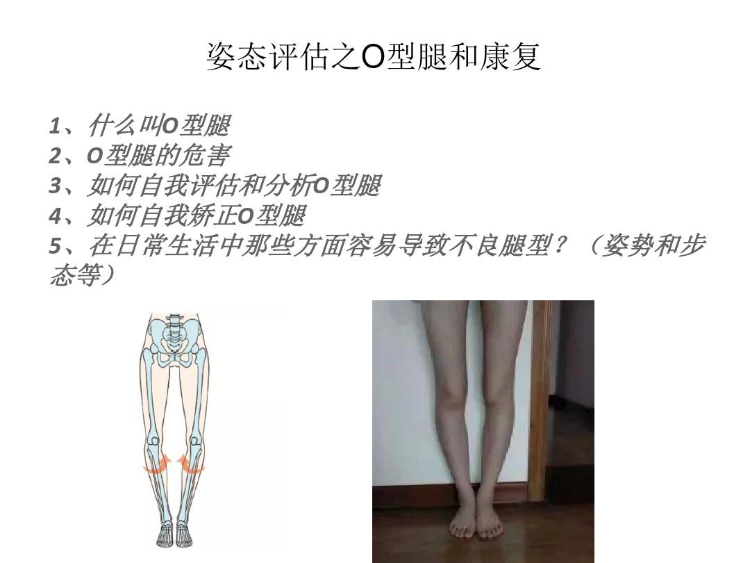 姿态评估之O型腿和康复