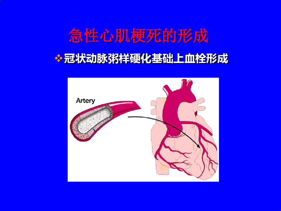 急性心肌梗死的心电图(讲课)