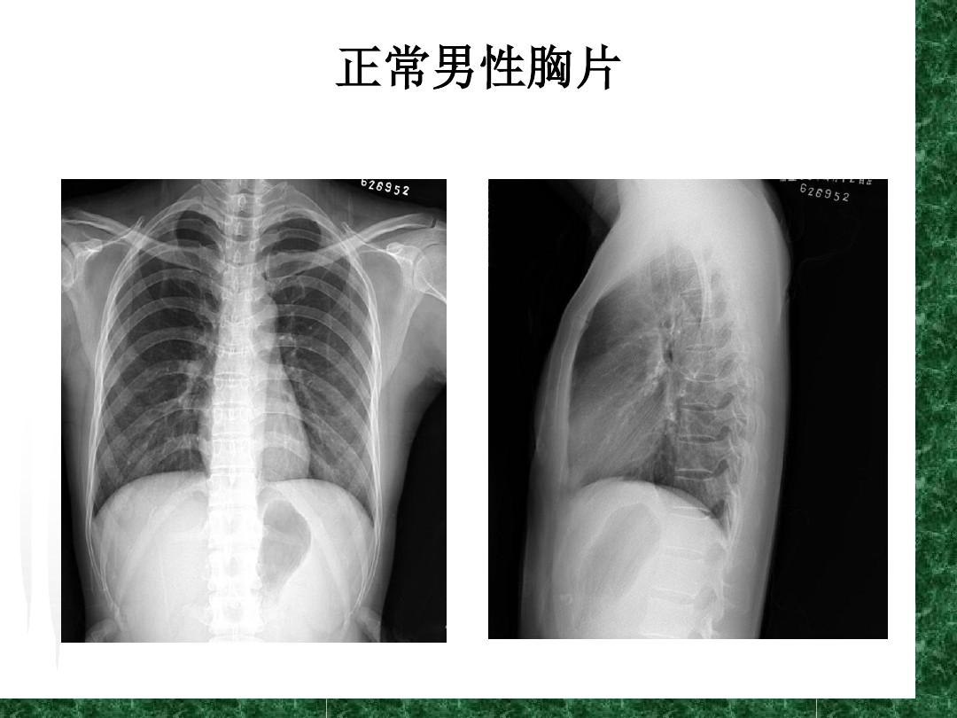 肺部断层影像解剖及肺部基本感染的影像学表现(二)