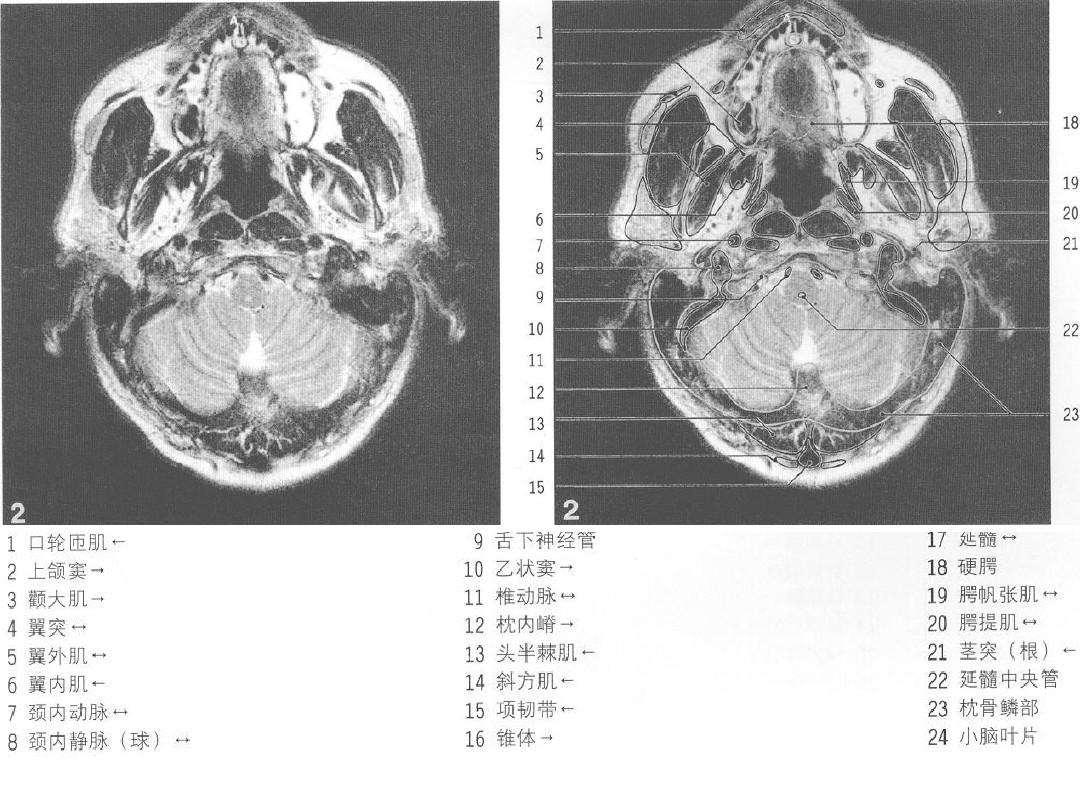 MRI颅脑横断解剖图谱(1)