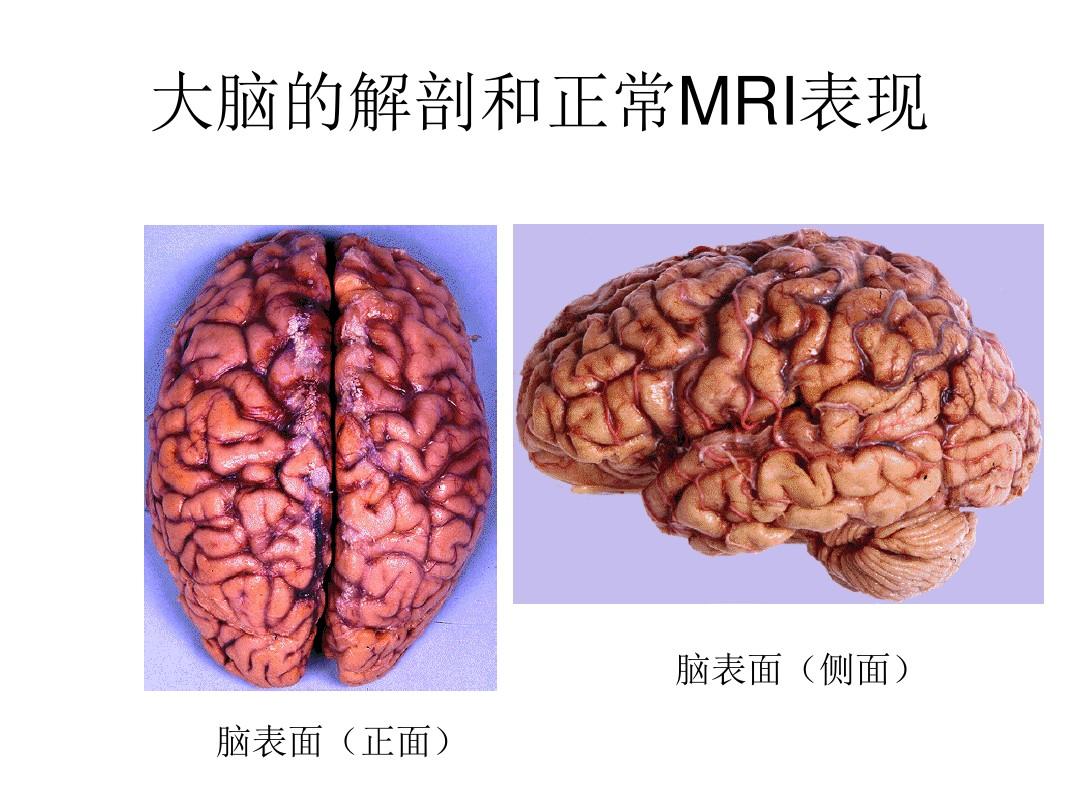 大脑的解剖和正常MRI表现