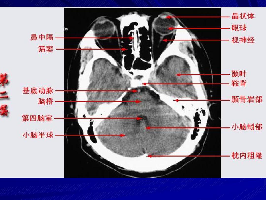 头颅CT断层解剖 PPT课件