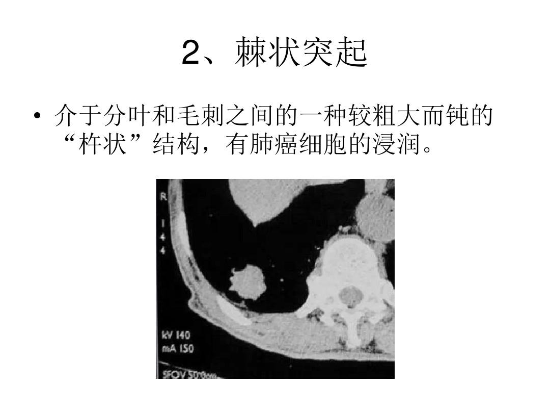 肺癌常见的七大CT影像特征