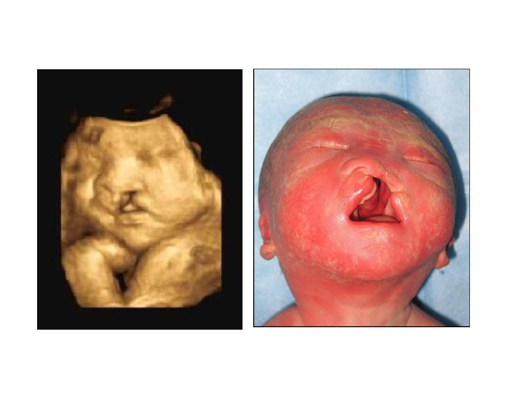 最新  胎儿腭裂的超声诊断