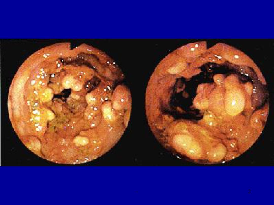 炎症性肠病(IBD)的肠外表现 ppt
