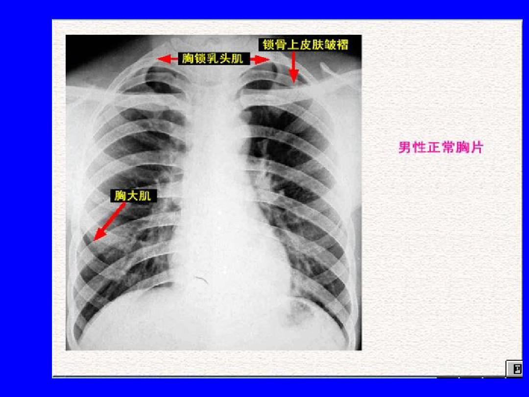 肺部正常和X线异常表现
