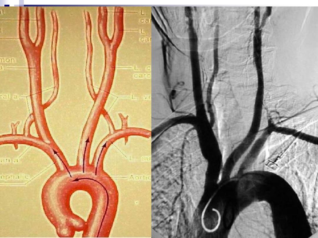 (完整PPT)脑血管造影(解剖及影像表现)