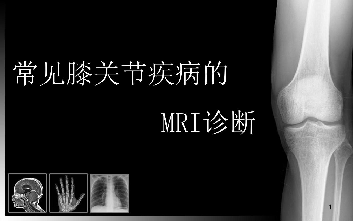 常见膝关节疾病的MRI诊断(医学材料)